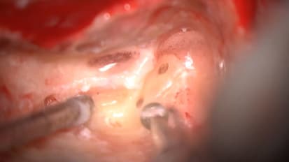 Mount Sinai Otolaryngology Surgical Series: Meniere’s Disease: Labyrinthectomy