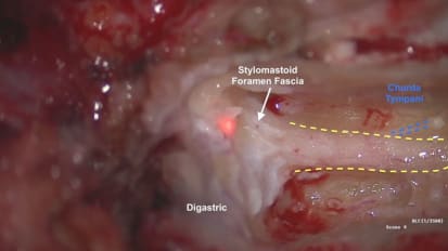 Mount Sinai Otolaryngology Surgical Series: Lateral Temporal Bone Resection (LTBR) with Facial Nerve Sacrifice