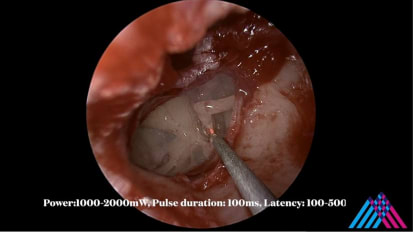 Mount Sinai Otolaryngology Surgical Series: Stapedectomy for Otosclerosis