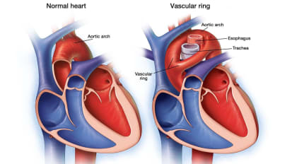 Vascular rings and slings: Mayo Clinic experience