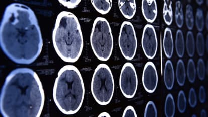 Mechanical Thrombectomy for Emergent Large Vessel Occlusion