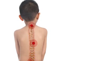 Common Spinal Deformities in Kids