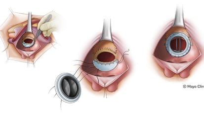 Novel mitral therapies — A Mayo Clinic perspective