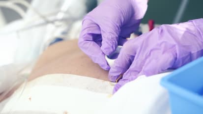 The SNAP™ Therapy System 