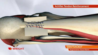 GRAFTJACKET™ Regenerative Tissue Matrix Achilles Animation [009128] 