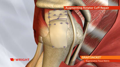 GRAFTJACKET™ Rotator Cuff Animation [009131]