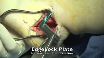 MAXLOCK EXTREME™ EDGELOCK- Dwyer Osteotomy Live Surgical Video [ORTHO-804-037]