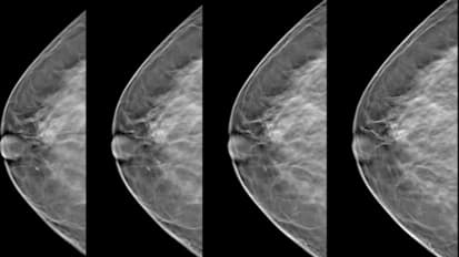 Clinical Minutes: 3D Tomosynthesis Mammography