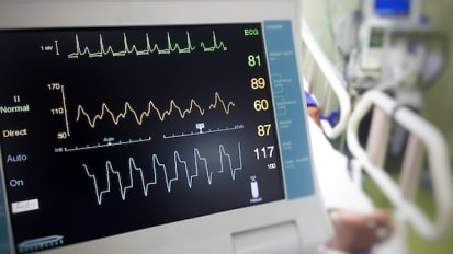 Clinical Minutes: Heart Rhythm Disturbances