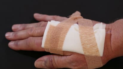 Understanding Stalled Non Healing Wounds