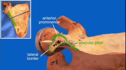 Shoulder Arthroplasty featuring the Aequalis Ascend™ Flex: Reversed Glenoid Exposure Technique - James Kelly, MD [CAW-6942] 