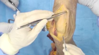 Elbow Arthroplasty featuring Latitude: Triceps-Tongue Exposure Technique - Shawn O'Driscoll, MD [CAW-1218]