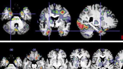 #TomorrowsDiscoveries: Recovering After a Stroke – Argye Hillis, M.D.