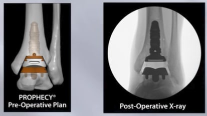 PROPHECY™ INBONE™ Total Ankle System Surgical Technique Animation [009238]