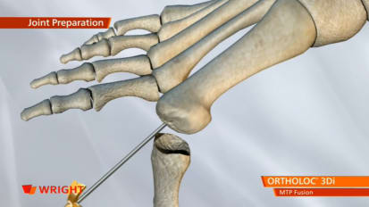 ORTHOLOC™ 3Di Foot Reconstruction System MTP Fusion Plate Animation [009116]