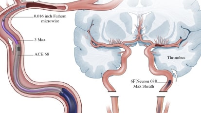 4.5 Minute Thrombectomy Using the ADAPT-FAST Technique and the ACE68 Catheter