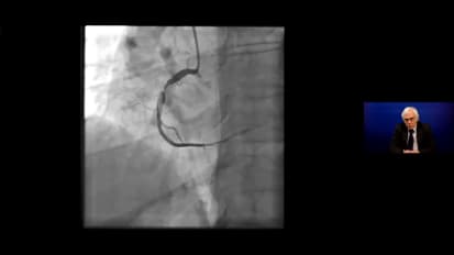 Cardiovascular Medicine webinar — ACS: Updates on classification, mechanisms and the role of early angiography