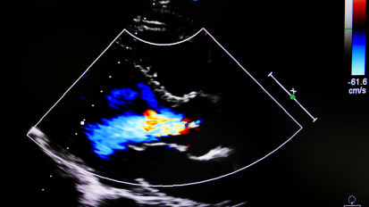 Advances in Catheter Based Therapies for Mitral Valve Disease: Transcatheter Mitral Valve Replacement & Repair