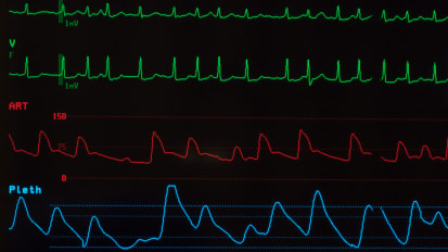 AFIB & Flutter Ablation