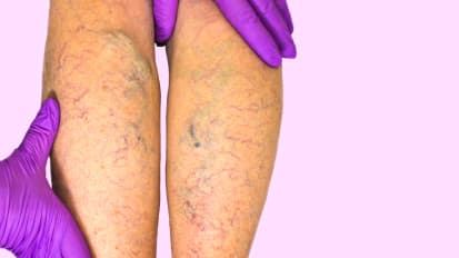 Chronic Venous Insufficiency: Caring for a Common and Disabling Condition