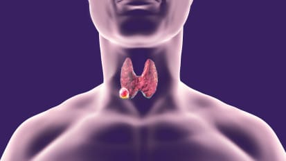 Thyroid Cancer: Incidence, Diagnosis, and Treatment