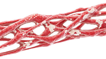 Marfan Syndrome and other Aortopathies