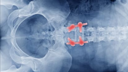 Complex Spine Surgery: Secrets of Successful Closure