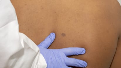 Neurofibromatosis Update: The Primary Care Provider’s Role and New Hope in Treating Tumors