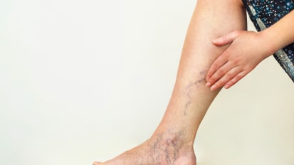 Veins, Venous Insufficiency and Varicose Veins