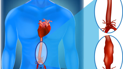 Endovascular Repair of Complex Aortic Aneurysms | Penn Medicine
