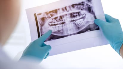 Osteoradionecrosis and Medication-Related Osteonecrosis