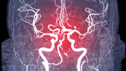 Thrombectomy for Large Vessel Occlusion