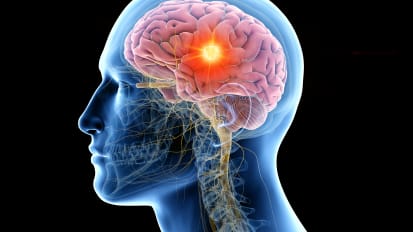 Case Presentation: Resection of a Large Cerebillopontine Angle Meningioma via the Retrosigmoid Approach