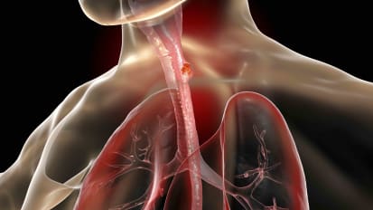 Esophageal Squamous Cell Carcinoma