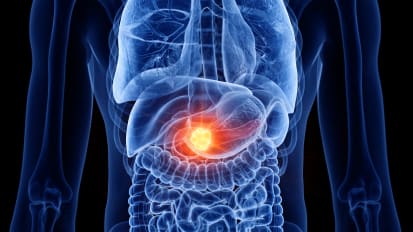 Identify Patients for High-Risk Pancreatic Cancer Screening