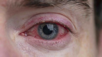 Seeing Red: A Guide to Identifying and Treating the Many Causes of a Red Eye