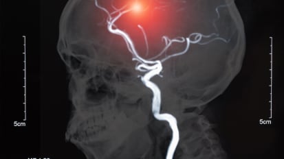 Lowering your strokes