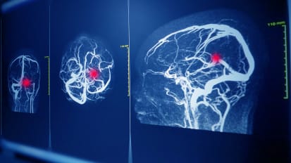 Vascular Conditions: Aneurysms & AVM