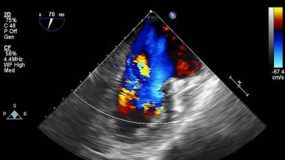 The Concept of Disproportionate Mitral Regurgitation