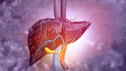 Update on Liver Lesions: What Works in Managing HCC