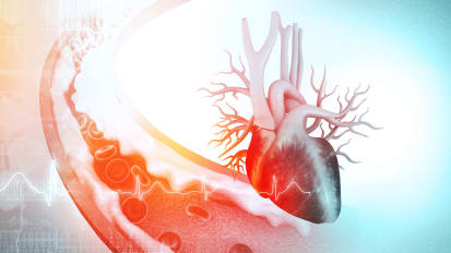 Endovascular Treatment of DVT