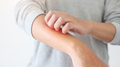 Soothing the Itch: How to Identify and Meet the Varied Needs of Patients With Eczema