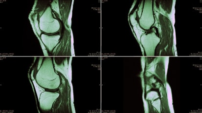 Keys to the Knees: How to Approach a Variety of Meniscus Tears