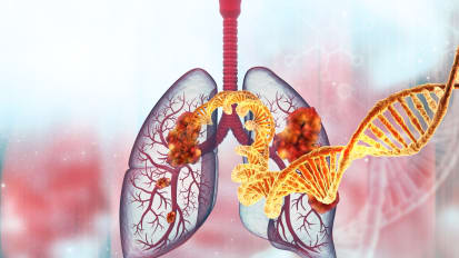 Immunotherapy in Lung Cancer Treatment