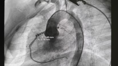 The Neonatal Cardiovascular Center of Excellence: Optimizing Support for Tiny Hearts