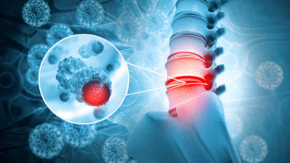 Chordoma with Mass General's Joseph Schwab: UC Davis Orthopaedics Lecture