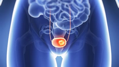 Muscle Invasive Bladder Cancer