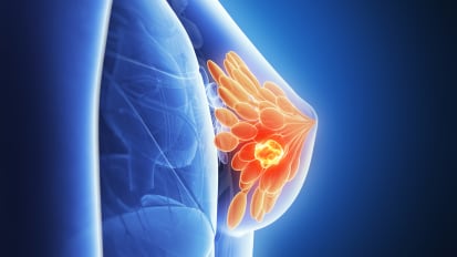 Study of SACI-IO for Triple Negative Metastatic Breast Cancer