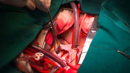 Grand Courts:LVAD病人选择2022:右方病人、右机设备、右机