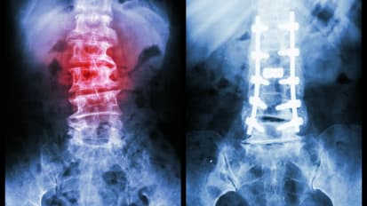 Awake Spinal Surgery Treatment Options